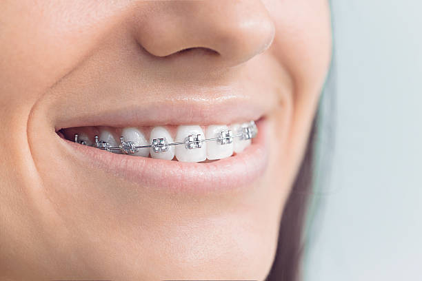 Best Veneers and Lumineers  in Gosport, IN